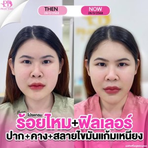 ประกาศ สินค้า ฉีดฟิลเลอร์อุดรธานี ลดริ้วรอย เสริมความงามอุด อุดร-ฉีดโบท็อก ยกกระชับ